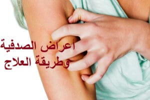 أسباب الصدفية psoriasis