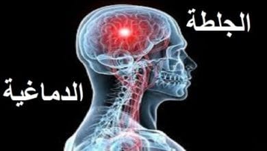 أنواع الجلطات الدماغية