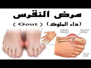 كيف يعالج داء النقرس