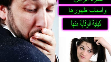 قشرة الرأس وأسباب